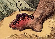 Gout - Wikipedia, the free encyclopedia